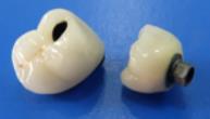 Dental Zirconia Crown Cercon义齿